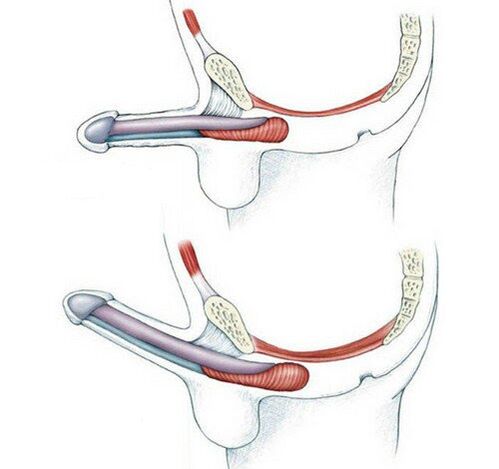 Penis without training the pubococcygeus -muscle and after